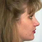 After Orthognathic (Jaw) Surgery