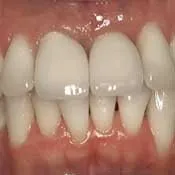 Dental Implant - After