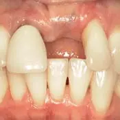Dental Implant - Before