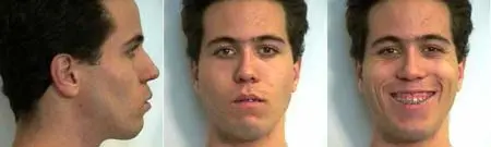 A before and after series showing a young man before jaw surgery, and after jaw surgery at Mission Valley Oral & Maxillofacial Surgery-San Diego.