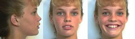 A before and after series showing a young woman before jaw surgery, and after jaw surgery at Mission Valley Oral & Maxillofacial Surgery-San Diego.