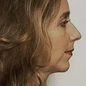 Orthognathic (Jaw) Surgery - After side view
