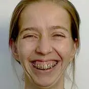Orthognathic (Jaw) Surgery - Before 