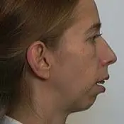 Orthognathic (Jaw) Surgery - Before side view