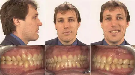 A before and after series showing a young man before jaw surgery, and after jaw surgery at Mission Valley Oral & Maxillofacial Surgery-San Diego.